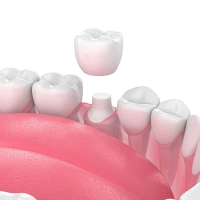 dental_crown-square-scaled400