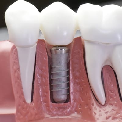 dental_implant-square 400