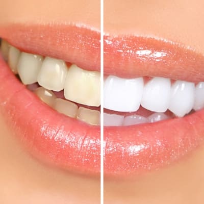 dental_teeth_whitening-square400
